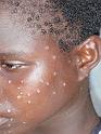 4  Monkey pox kill hundreds of Congolese every year. Most of the patients never reacht the hospital in time.